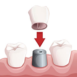 dental implant Columbus OH
